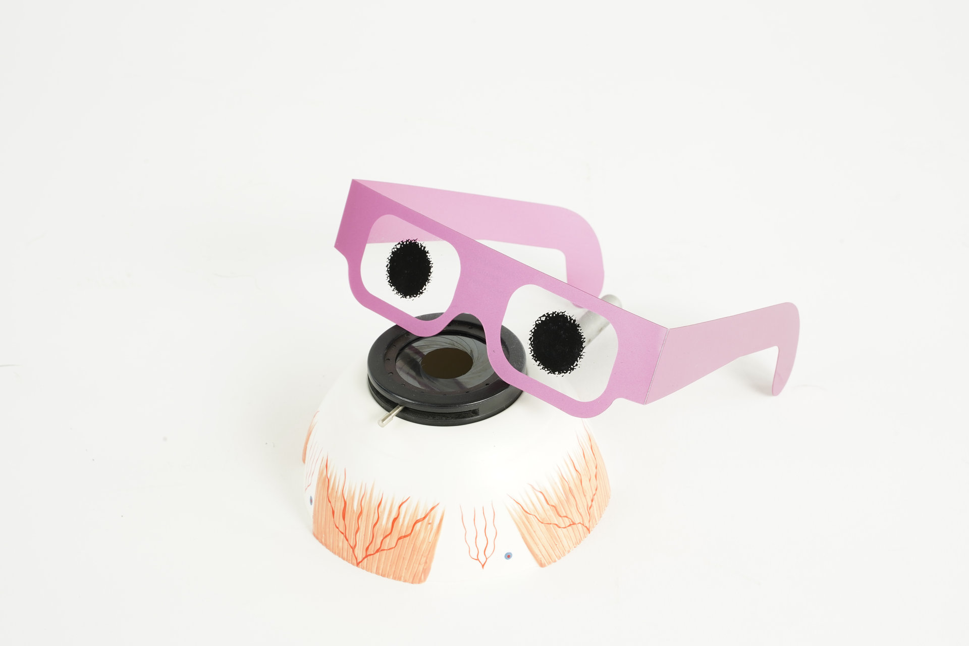 Age-related macular degeneration